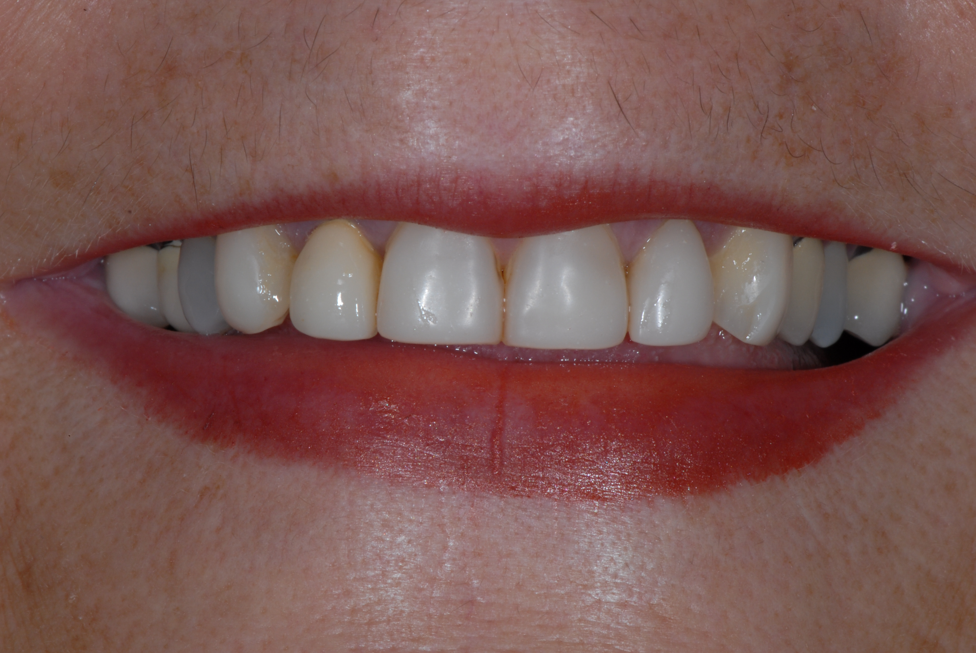 Porcelain Veneers - Cosmetic Dentistry Porcelain Veneers - Cosmetic Dentistry