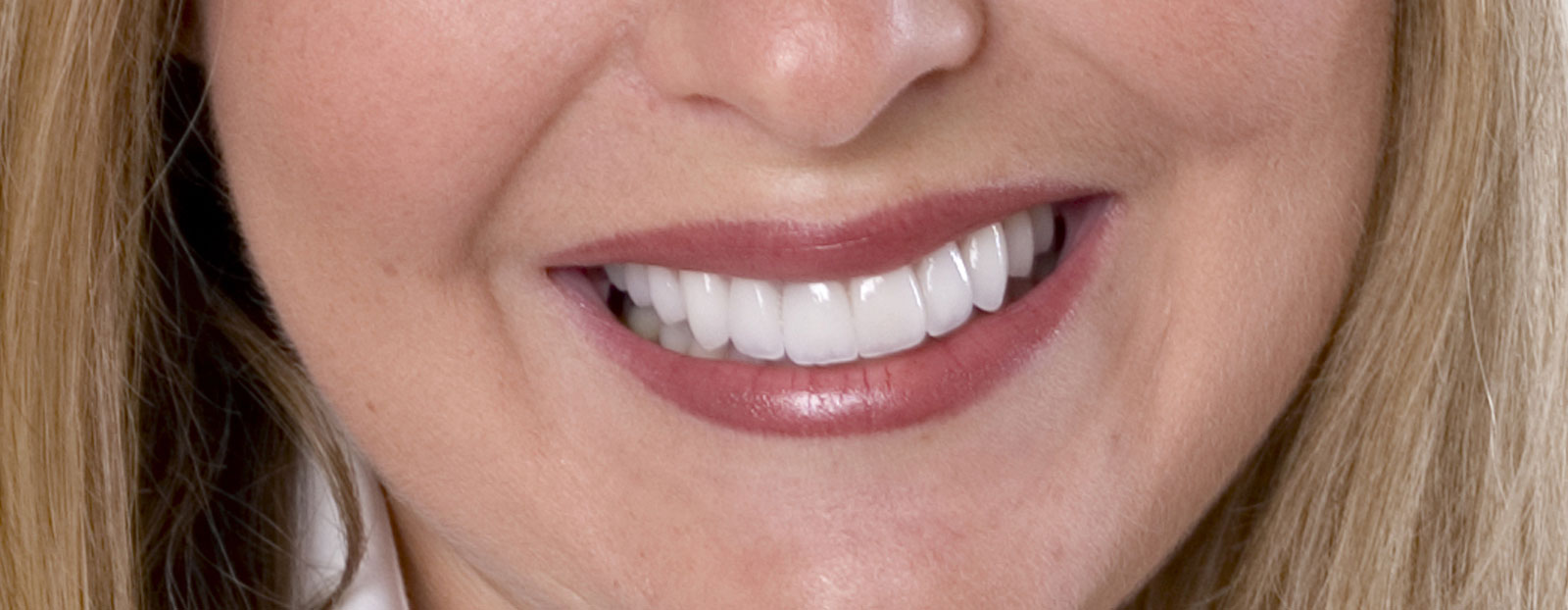 Porcelain Veneers - Cosmetic Dentistry Porcelain Veneers - Cosmetic Dentistry