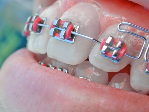 braces article