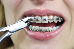 braces-do-it-yourself