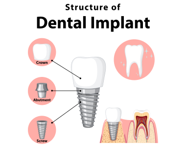 Dental Implants Dayton Ohio